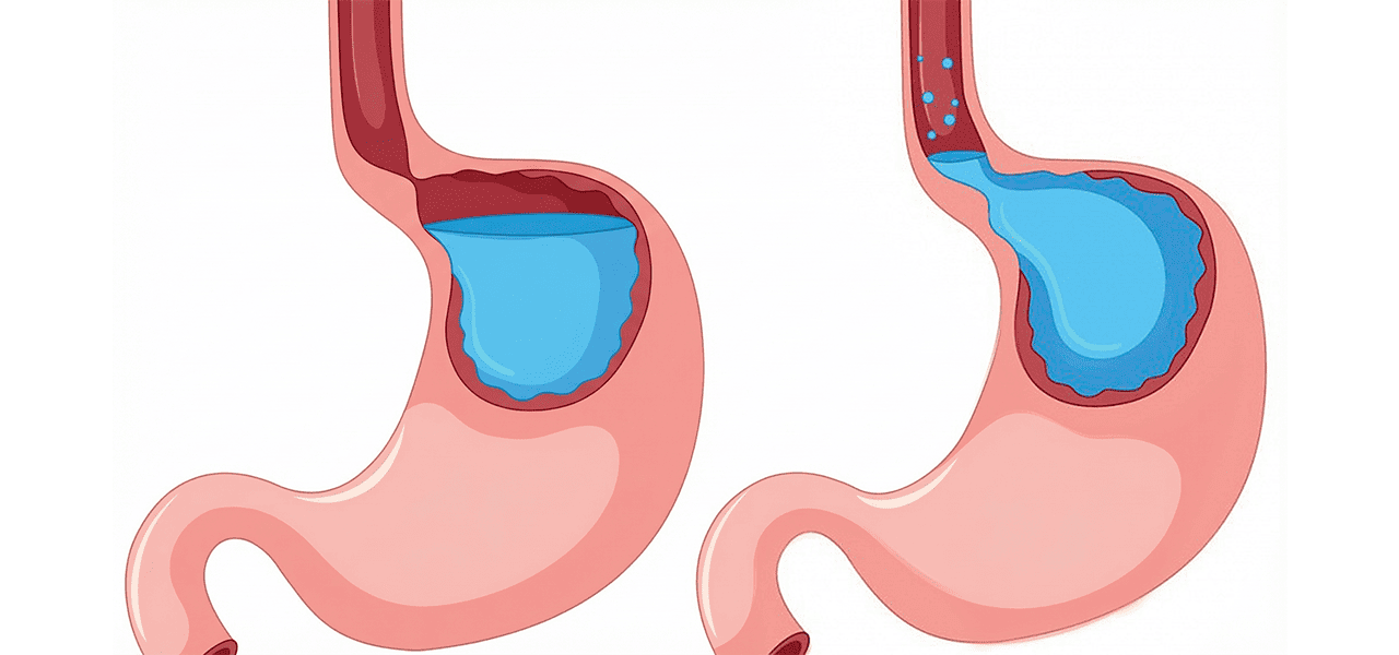 Рефлюкс-эзофагит (ГЭРБ)