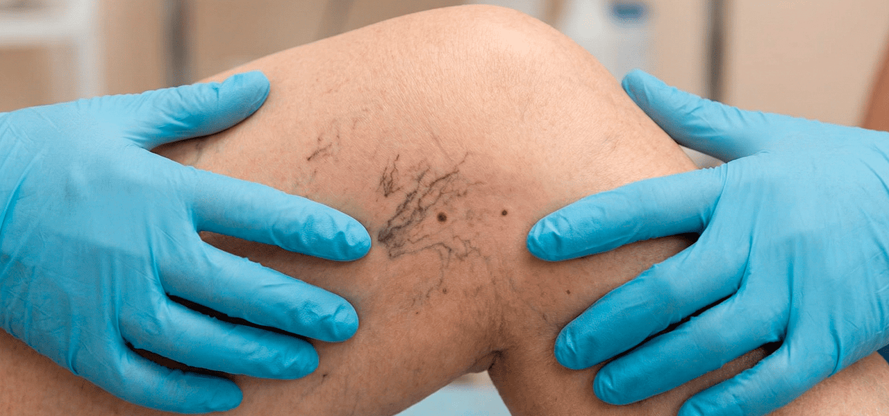 Сосудистые звездочки