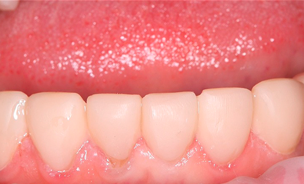 Шинирование с одномоментным восстановлением эстетики