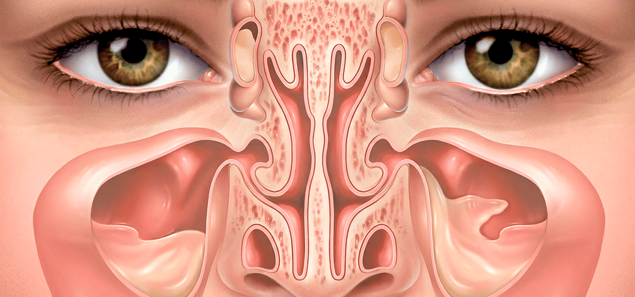 Полисинусит