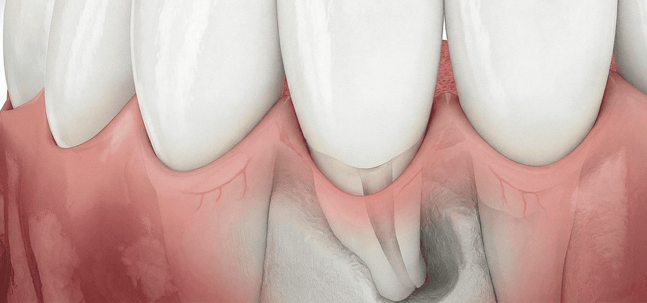 Рецессия десны