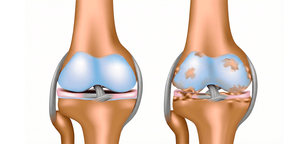 Остеоартроз