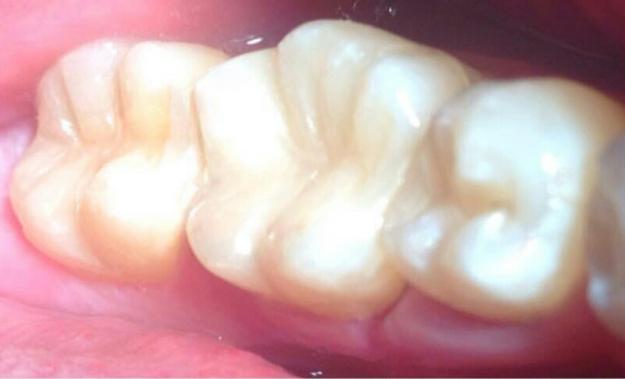 Безболезненное лечение кариеса