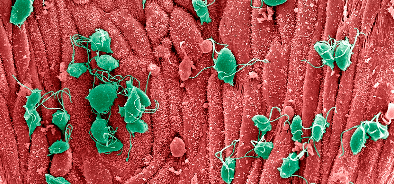 Трихомониаз