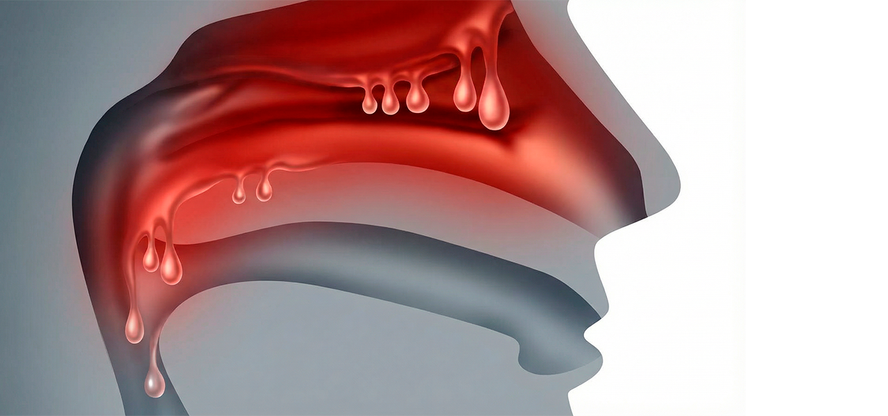 Воспаление слизистой носа