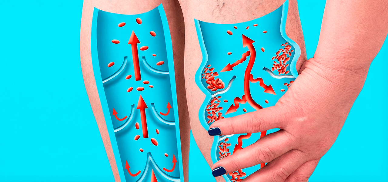 Хроническая венозная недостаточность (XBH)