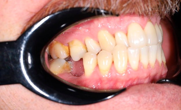 Установка импланта