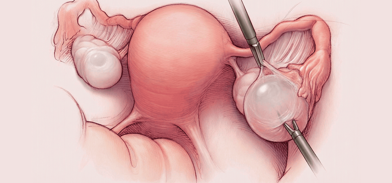 Эндометриоидная киста яичника