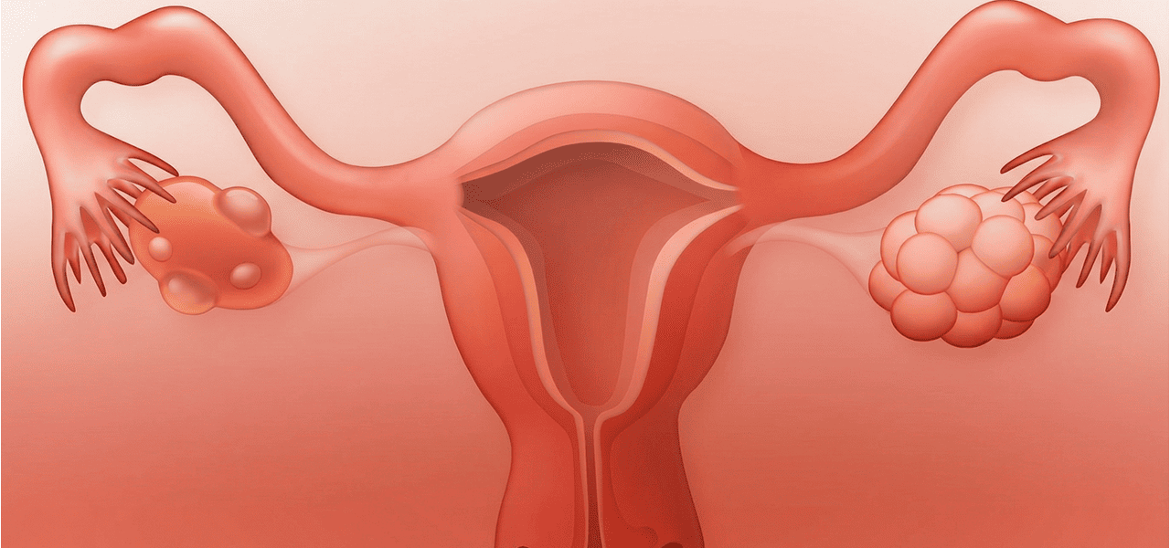 Поликистоз яичников