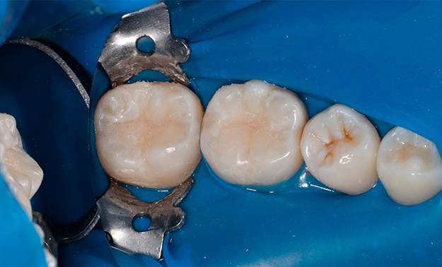 Лечение кариеса, реставрация двух жевательных зубов