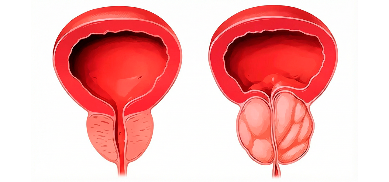 Воспаление предстательной железы