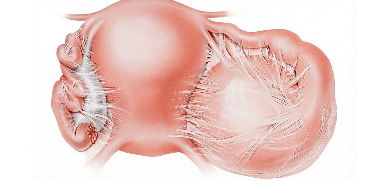 Спаечный процесс в малом тазу