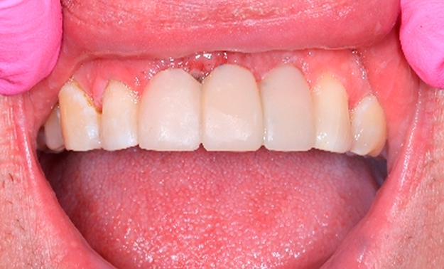 Удаление и шинирование с восстановлением эстетики