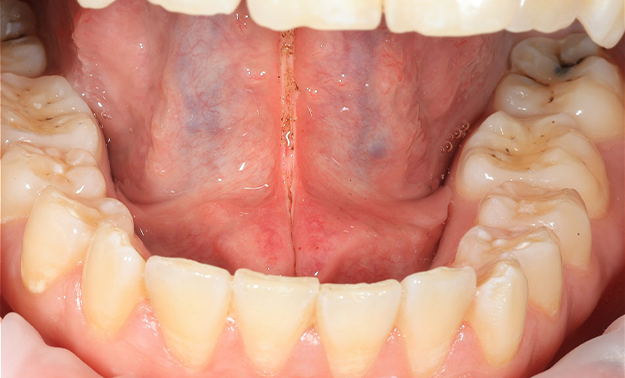 Пластика уздечки языка диодным хирургическим лазером