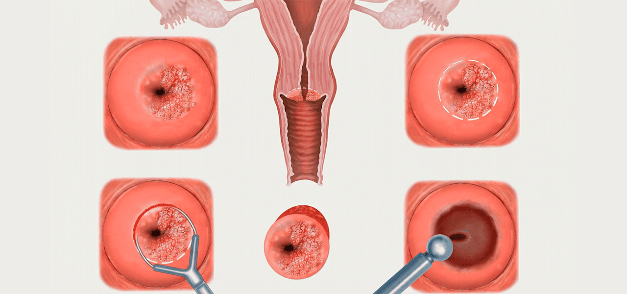 Эрозия шейки матки