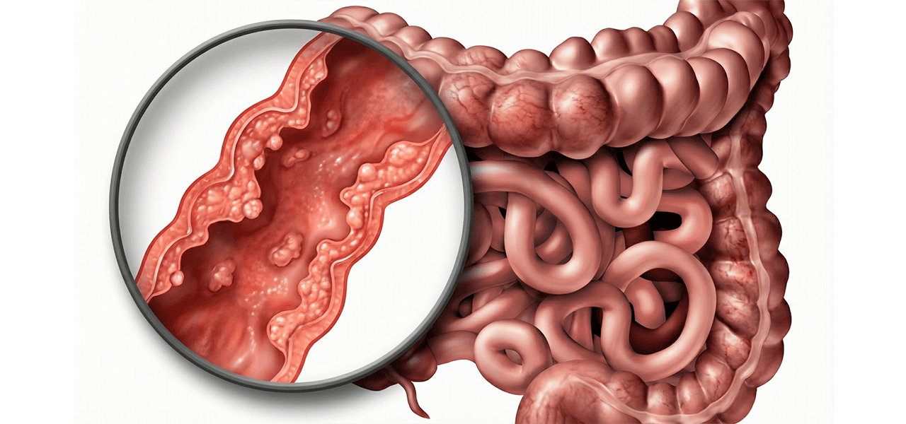 Болезнь Крона