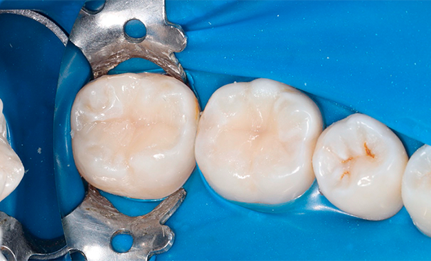 Лечение кариеса постановка композитной пломбы