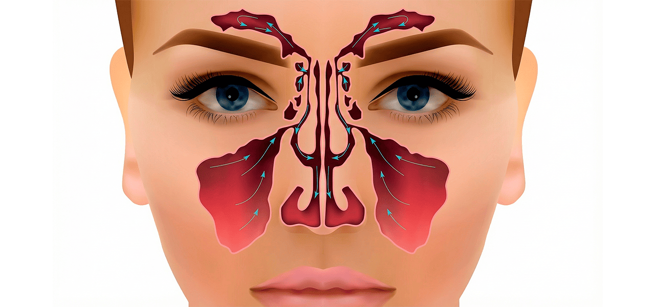 Кисты околоносовых пазух