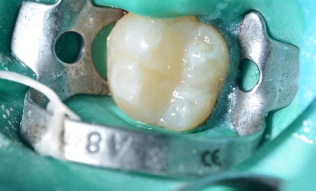 Постановка пломб