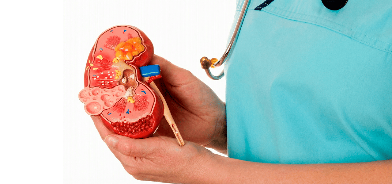 Киста почки