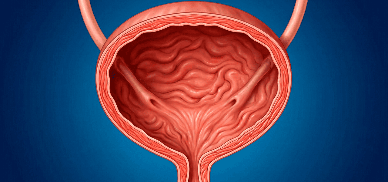 Склероз шейки мочевого пузыря
