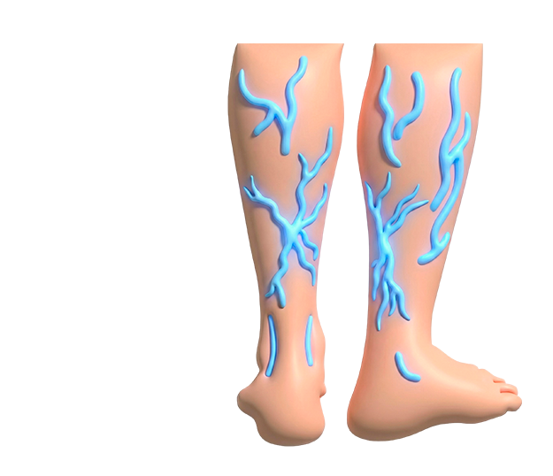 Варикозу - нет!