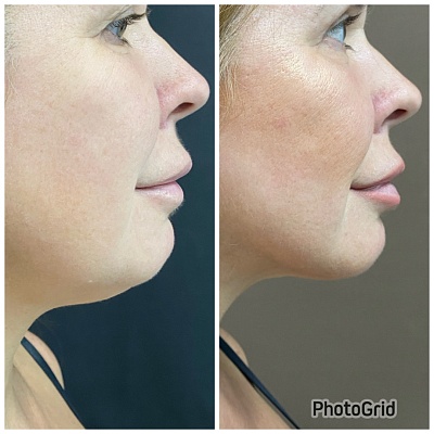 Липосакция шеи