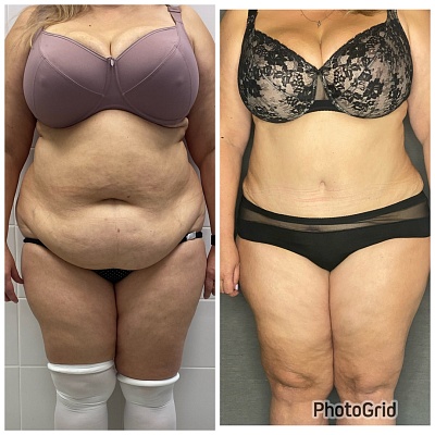 Абдоминопластика с перемещением пупка, ушиванием диастаза прямых мышц живота и липосакцией боков