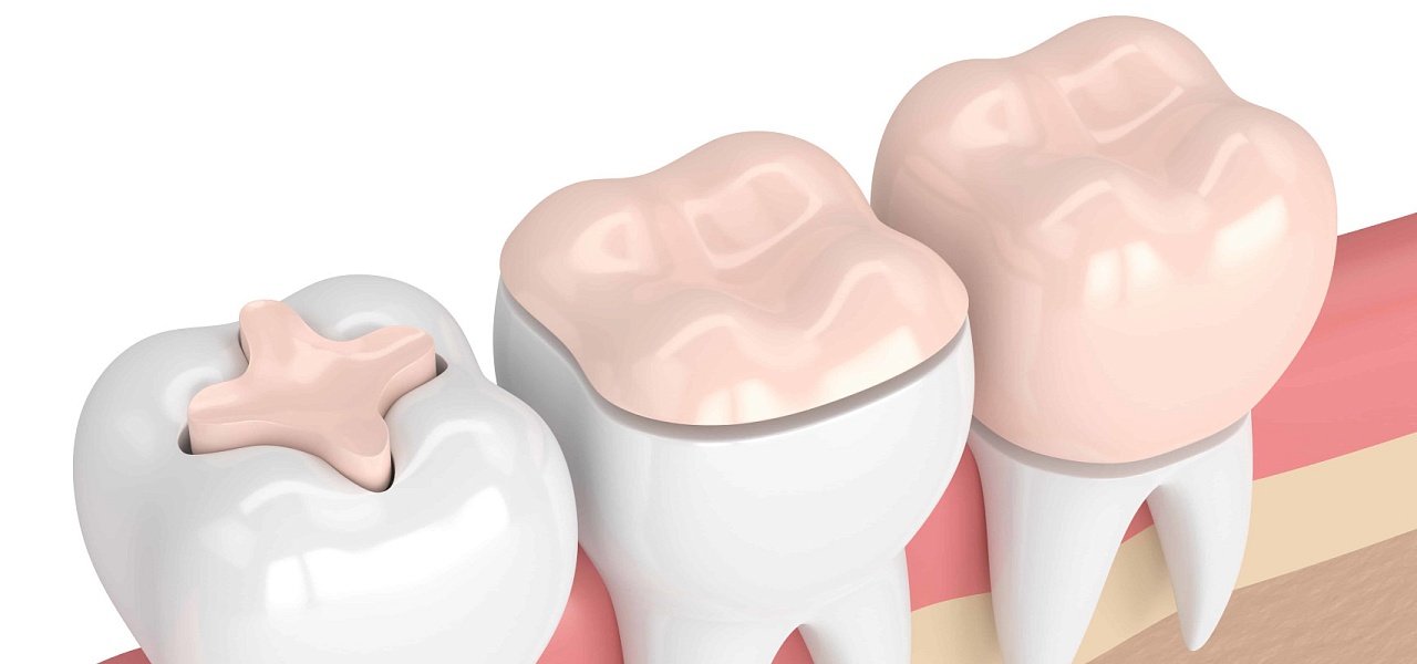 Что такое вкладка и чем она отличается от обычной пломбы