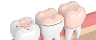 Что такое вкладка и чем она отличается от обычной пломбы