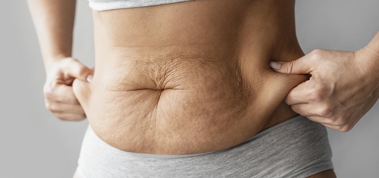 Как убрать обвисший живот Как убрать обвисший живот