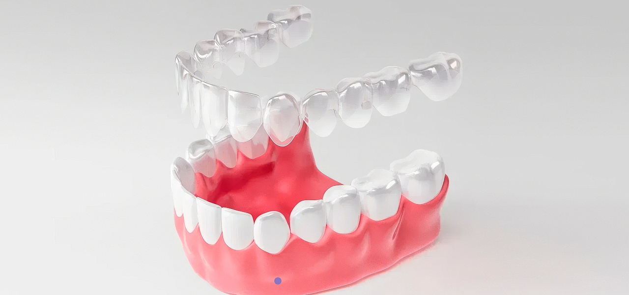 Невидимая ортодонтия: всё об элайнерах и их преимуществах