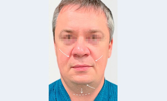 До процедуры 