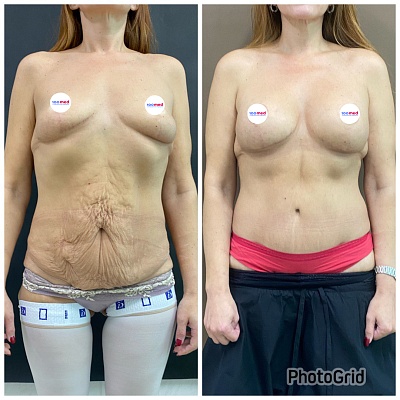 Абдоминопластика с перемещением пупка и ушиванием диастаза прямых мышц живота+ маммопластика круглыми имплантами