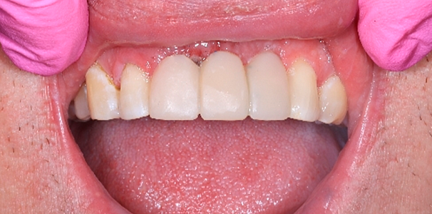 После лечения 