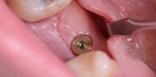 После лечения 