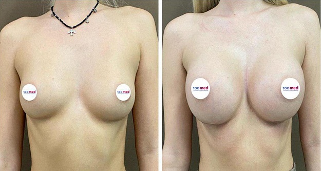 Увеличение груди круглыми имплантами
