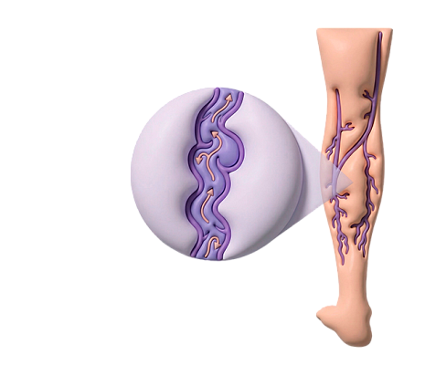 Варикозу - нет!