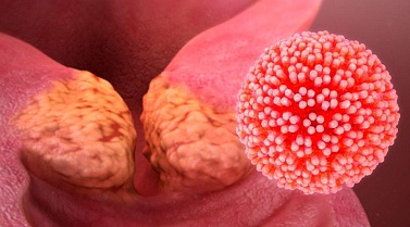 Защититесь от рака шейки матки