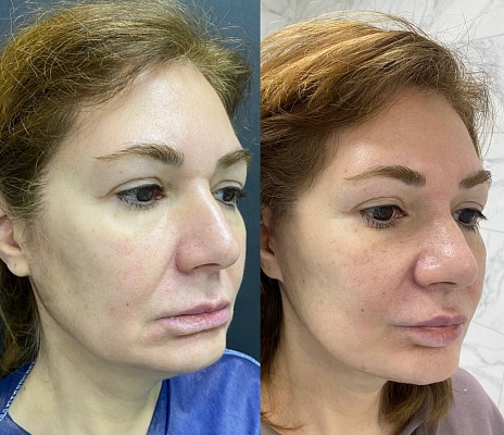 Подтяжка лица и шеи SMAS lifting