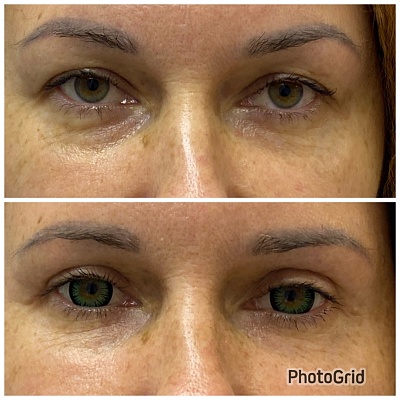 Верхняя блефаропластика