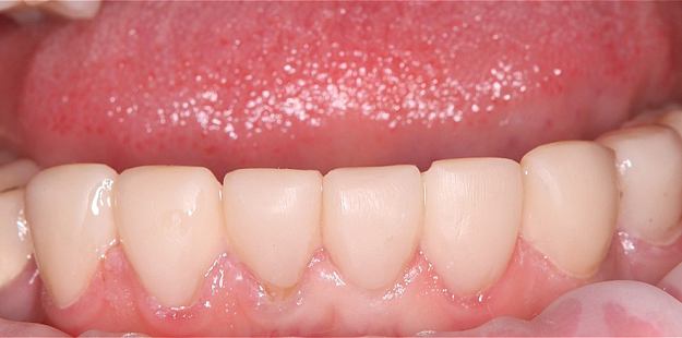 После лечения 