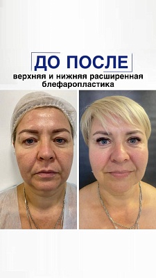 Верхняя и нижняя расширенная блефаропластика