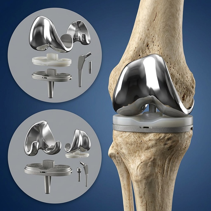 Замена коленного сустава
