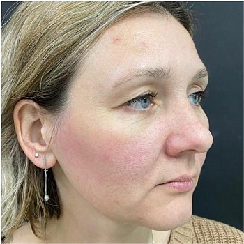 До операции 