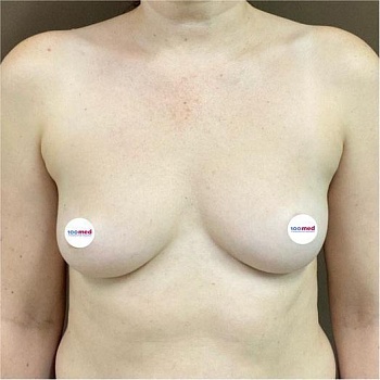 До операции 