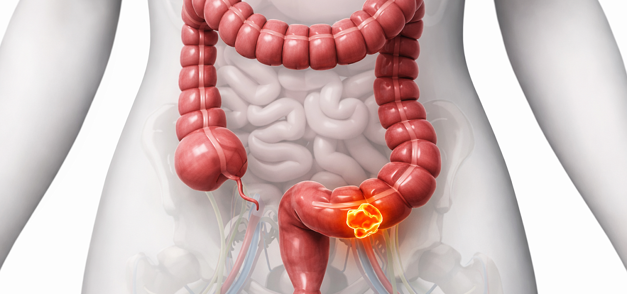 Воспаление толстого кишечника