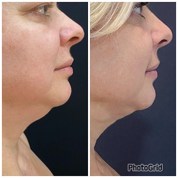 До операции 