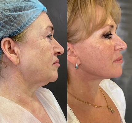 SMAS lifting, медиальная платизмопластика