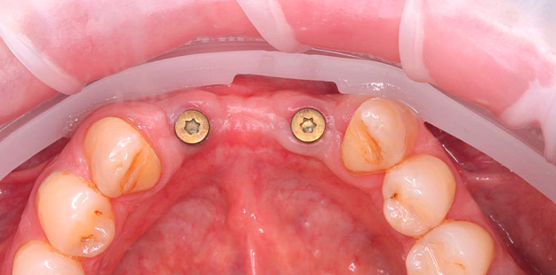 После лечения 